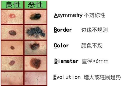 好痣顏色|【好痣壞痣怎麼分】好痣壞痣怎麼分？3招學會分辨，別再胡亂點。